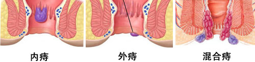 痔疮的 治疗方法